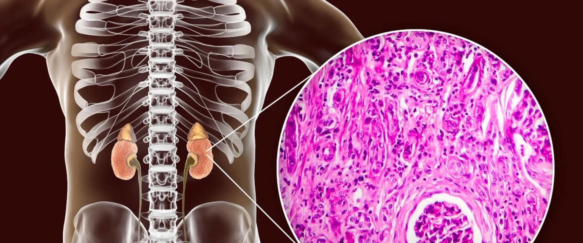 What Is FSGS? Uncover the Truth About This Kidney Threat