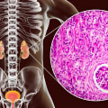 What Is FSGS? Uncover the Truth About This Kidney Threat