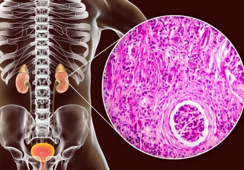 Uncovering the Truth About FSGS: A Comprehensive Guide